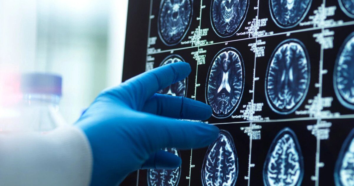O nouă hartă detaliată a îmbătrânirii creierului dezvăluie vulnerabilități genetice Îmbătrânirea creierului nu este un proces unitar, iar cercetătorii au identificat pentru prima dată o hartă detaliată a modului în care factorii genetici influențează acest fenomen