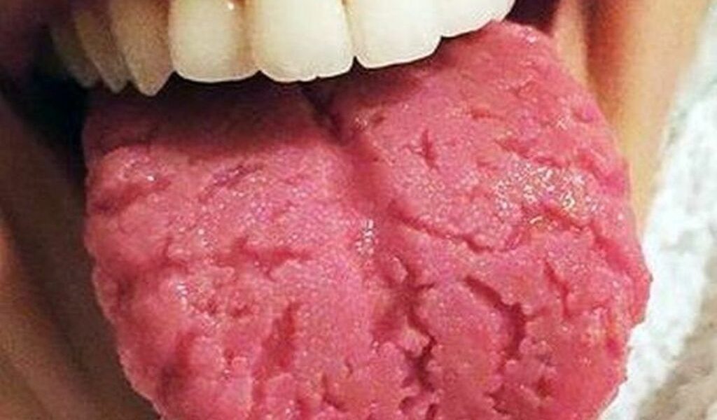 Limba crăpată: De la disconfort la potențiale probleme de sănătate Apariția crăpăturilor pe suprafața limbii poate semnala dezechilibre în organism, de la deshidratare și deficiențe nutriționale până la probleme digestive sau stres