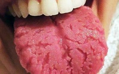 Limba crăpată: De la disconfort la potențiale probleme de sănătate Apariția crăpăturilor pe suprafața limbii poate semnala dezechilibre în organism, de la deshidratare și deficiențe nutriționale până la probleme digestive sau stres