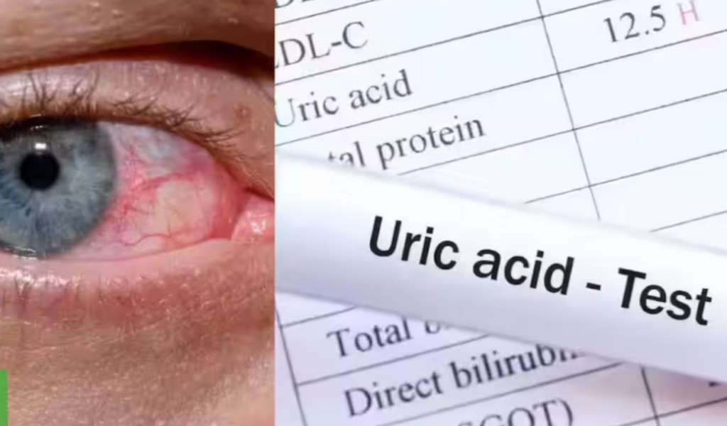 Acidul uric crescut: Un pericol tăcut pentru sănătate Un nivel ridicat de acid uric în sânge, cunoscut sub denumirea medicală de hiperuricemie, poate fi un indicator al unor probleme grave de sănătate