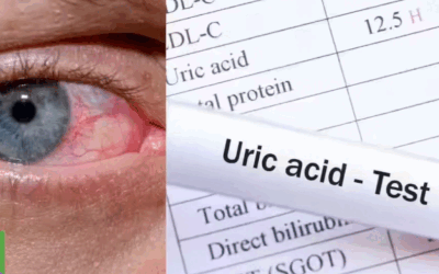 Acidul uric crescut: Un pericol tăcut pentru sănătate Un nivel ridicat de acid uric în sânge, cunoscut sub denumirea medicală de hiperuricemie, poate fi un indicator al unor probleme grave de sănătate