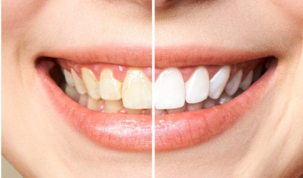 Dinții îngălbeniți: cauze, prevenire și soluții Aspectul dinților poate fi afectat de o serie de factori, ducând la decolorare și la o nuanță galbenă inestetică