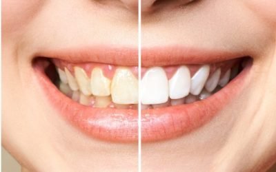 Dinții îngălbeniți: cauze, prevenire și soluții Aspectul dinților poate fi afectat de o serie de factori, ducând la decolorare și la o nuanță galbenă inestetică