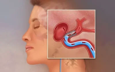 Atenție la semnalele creierului: doi indicatori cu risc major de anevrism cerebral Un medic neurolog avertizează asupra a două simptome care nu trebuie ignorate, deoarece pot semnala o afecțiune gravă: anevrismul cerebral