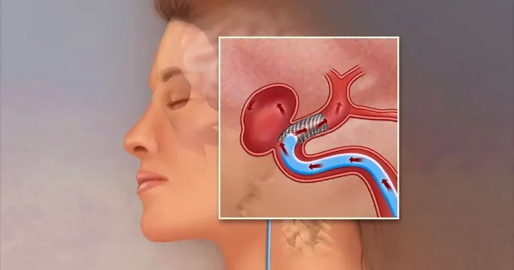 Atenție la semnalele creierului: doi indicatori cu risc major de anevrism cerebral Un medic neurolog avertizează asupra a două simptome care nu trebuie ignorate, deoarece pot semnala o afecțiune gravă: anevrismul cerebral