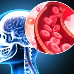 Supliment: Scade riscul de infarct și AVC cu până la 43%