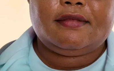 Bărbia dublă, mai mult decât o problemă estetică: semnal de alarmă pentru sănătatea metabolică Acumularea de grăsime în zona gâtului, cunoscută sub denumirea de „bărbie dublă”, poate semnala probleme de sănătate mai profunde, depășind sfera aspectului fizic