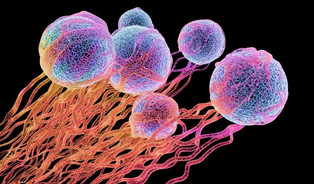 Microplasticul, legat de cancerul de prostată? Un studiu ridică semne de întrebare Un studiu recent, realizat de cercetători de la NYU Langone Health, a scos la iveală o posibilă legătură între expunerea la microplastic și dezvoltarea cancerului de prostată