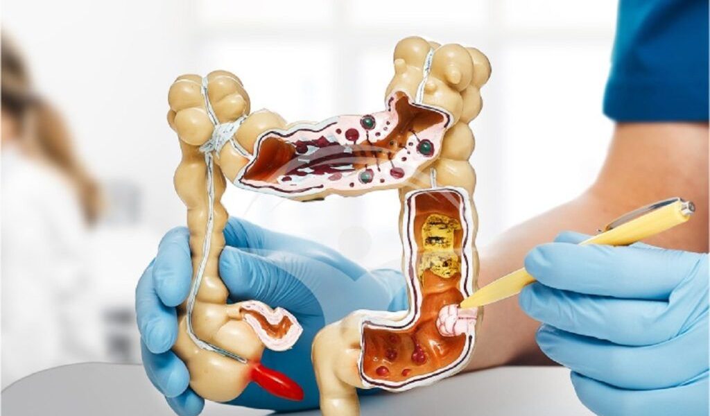 Cancerul de colon: atenție la sânge în scaun și alte semnale de alarmă Cancerul de colon este o boală frecventă, dar adesea tratabilă, cu condiția să fie depistată din timp