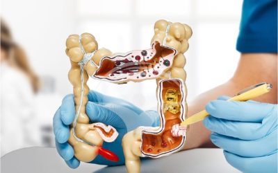 Cancerul de colon: atenție la sânge în scaun și alte semnale de alarmă Cancerul de colon este o boală frecventă, dar adesea tratabilă, cu condiția să fie depistată din timp