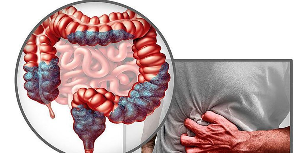 Cancerul colorectal, o boală tot mai frecventă la tineri: un studiu arată schimbări în structura colonului Medicii avertizează că alimentația joacă un rol crucial în prevenirea cancerului colorectal, o boală care apare din ce în ce mai des la persoane sub 50 de ani