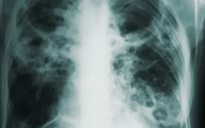 Arcul de Triumf, iluminat roșu pentru Ziua luptei anti-TBC