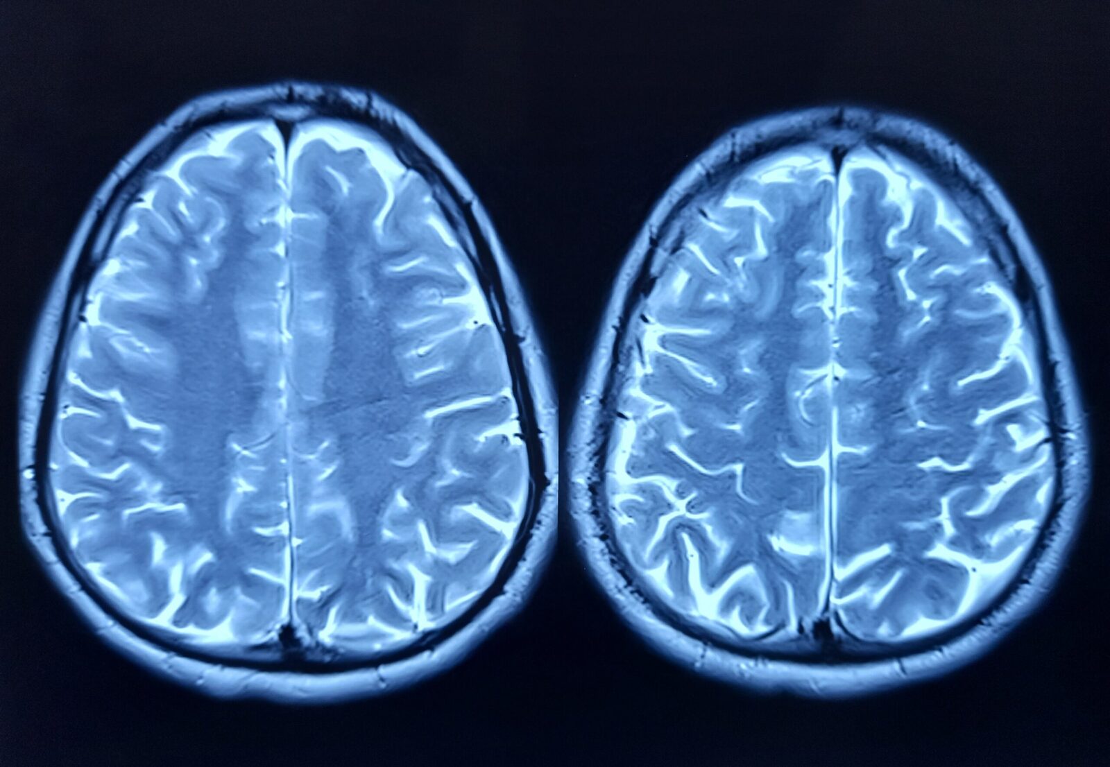 Neuroni umani, conectați la cipuri de siliciu, antrenați să joace Doom Un pas important spre dezvoltarea calculatoarelor biologice programabile a fost realizat de o echipă de cercetători