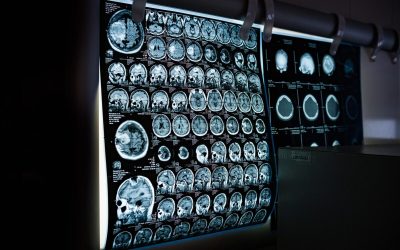 Un creier criogenat după moartea unui cercetător a fost examinat după mai bine de un deceniu de conservare la temperaturi extrem de scăzute, oferind noi perspective asupra posibilităților și limitelor criogeniei