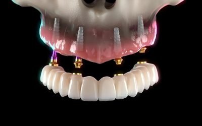 Dinți ficși în 24 de ore: o soluție pentru pacienții cu probleme dentare Multe persoane se confruntă cu probleme dentare, adoptând diverse compromisuri pentru a face față situației