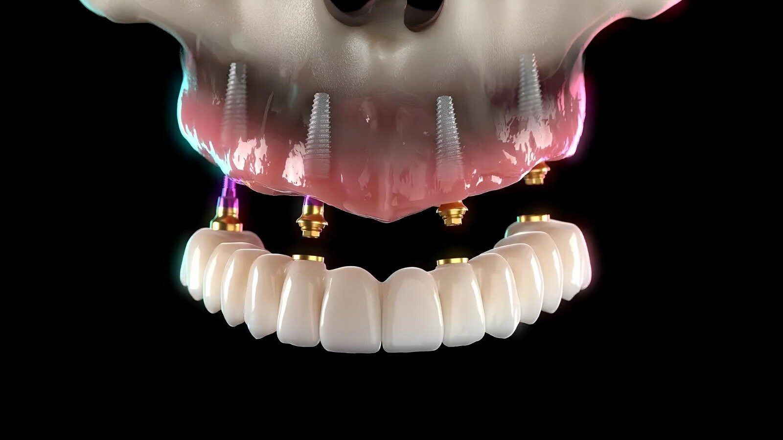 Dinți ficși în 24 de ore: o soluție pentru pacienții cu probleme dentare Multe persoane se confruntă cu probleme dentare, adoptând diverse compromisuri pentru a face față situației