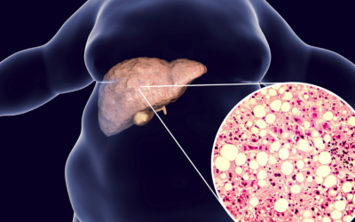 Substanțe din cannabis, un posibil tratament pentru boala ficatului gras Oamenii de știință au descoperit că două substanțe derivate din planta de canabis ar putea oferi o nouă abordare în tratamentul bolii hepatice asociate disfuncției metabolice (MASLD)