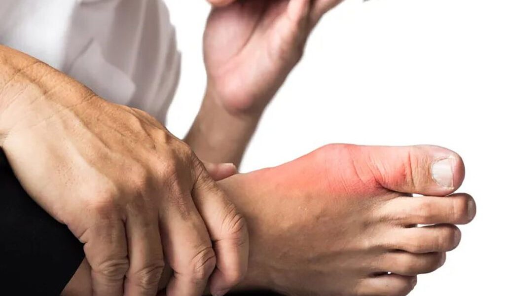 Guta: Cum afectează alimentația o boală articulară frecventă Guta, o formă de artrită inflamatorie, provoacă episoade dureroase, înroșirea și umflarea articulațiilor, în special la nivelul degetului mare de la picior