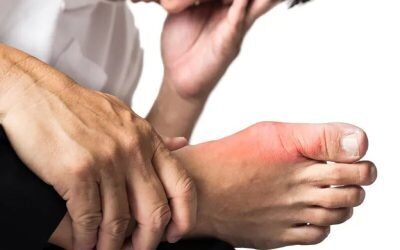 Guta: Cum afectează alimentația o boală articulară frecventă Guta, o formă de artrită inflamatorie, provoacă episoade dureroase, înroșirea și umflarea articulațiilor, în special la nivelul degetului mare de la picior