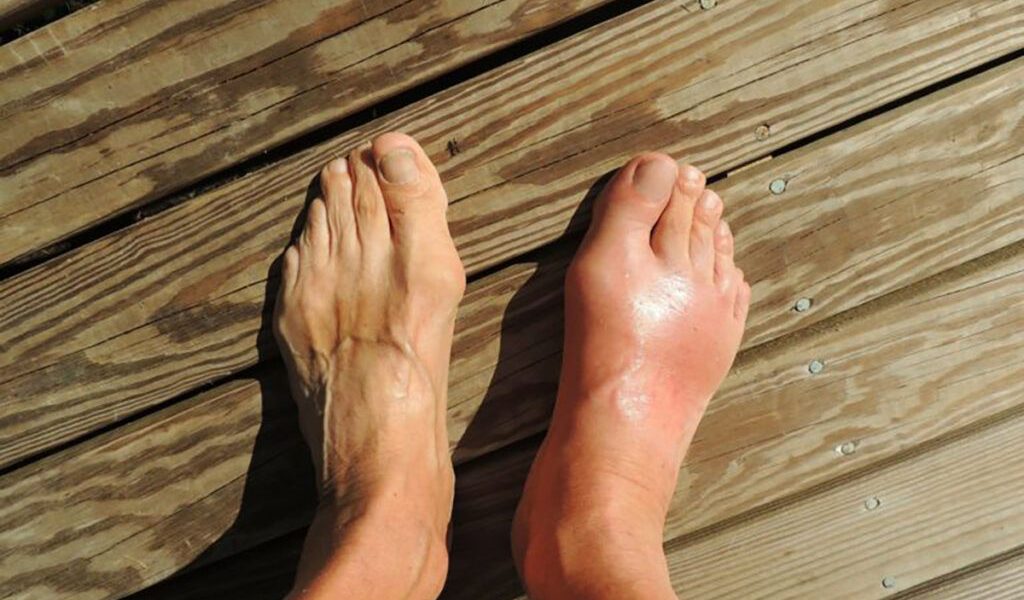 Acidul uric crescut: De ce analizele pot arăta valori surprinzătoare și ce implică Un rezultat neașteptat la analizele de sânge, care indică un nivel ridicat de acid uric, poate stârni îngrijorare