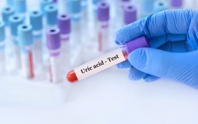 Acidul uric crescut: Cauze surprinzătoare dincolo de dietă Un rezultat neașteptat la analizele de sânge, anume niveluri crescute de acid uric, poate stârni îngrijorare, mai ales când regimul alimentar nu a suferit modificări