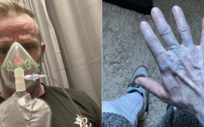 Bărbat din Marea Britanie, transformat temporar într-un „Avatar” din cauza unor cearșafuri noi Un bărbat din Marea Britanie a ajuns de urgență la spital, speriat de aspectul său neobișnuit: pielea complet albastră