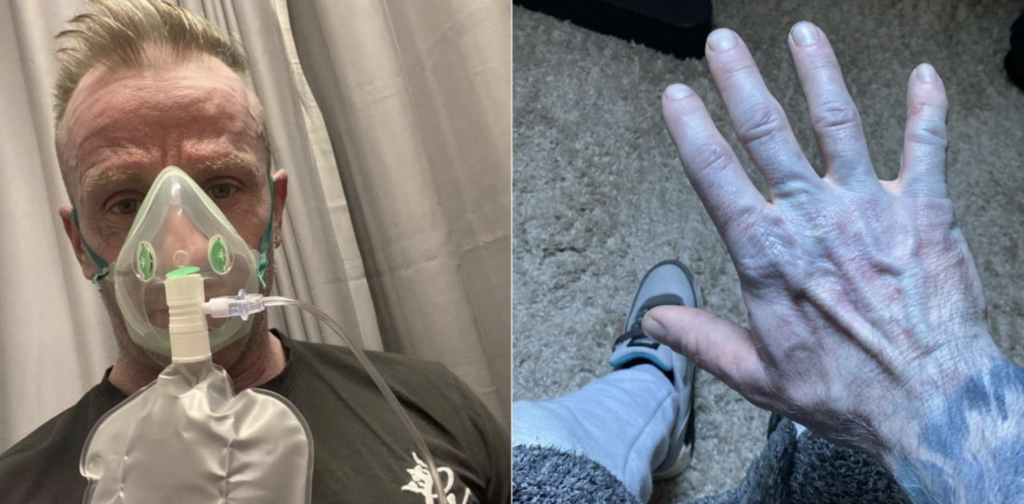 Bărbat din Marea Britanie, transformat temporar într-un „Avatar” din cauza unor cearșafuri noi Un bărbat din Marea Britanie a ajuns de urgență la spital, speriat de aspectul său neobișnuit: pielea complet albastră