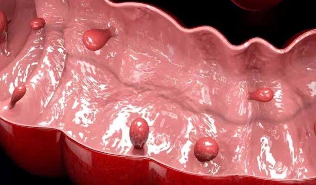 Polipii sesili: Leziunea silențioasă din colon care crește riscul de cancer
(Ce sunt și când devin periculoși)