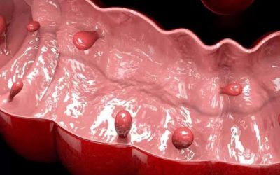 Polipii sesili: Leziunea silențioasă din colon care crește riscul de cancer
(Ce sunt și când devin periculoși)