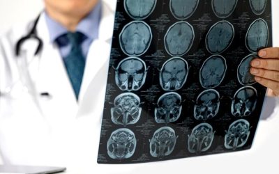 Apolipoproteina B: Un indicator ignorat în evaluarea riscului de accident vascular cerebral Monitorizarea regulată a colesterolului este o practică uzuală în România, însă medicii avertizează că aceasta ar putea să nu ofere o imagine completă asupra riscului de accident vascular cerebral (AVC)