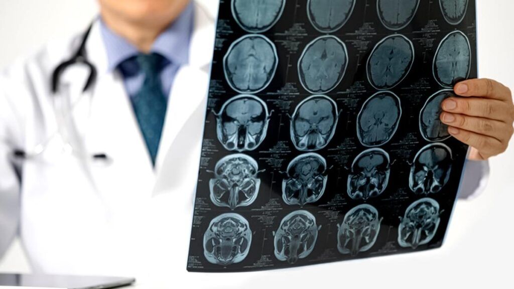 Apolipoproteina B: Un indicator ignorat în evaluarea riscului de accident vascular cerebral Monitorizarea regulată a colesterolului este o practică uzuală în România, însă medicii avertizează că aceasta ar putea să nu ofere o imagine completă asupra riscului de accident vascular cerebral (AVC)