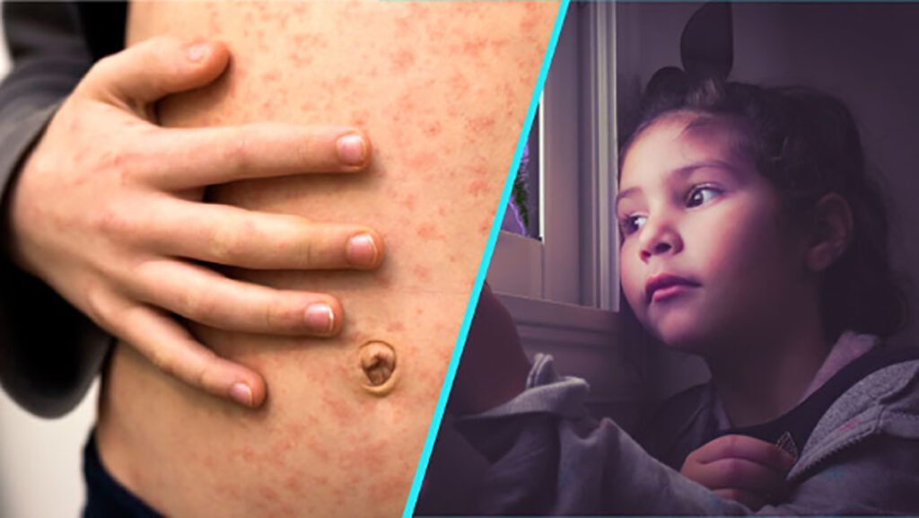 Alertă de sănătate: Rujeola ajunge în Noua Zeelandă după un zbor internațional Un nou focar de rujeolă a generat îngrijorare în Noua Zeelandă, după ce doi pasageri infectați au călătorit cu un zbor internațional