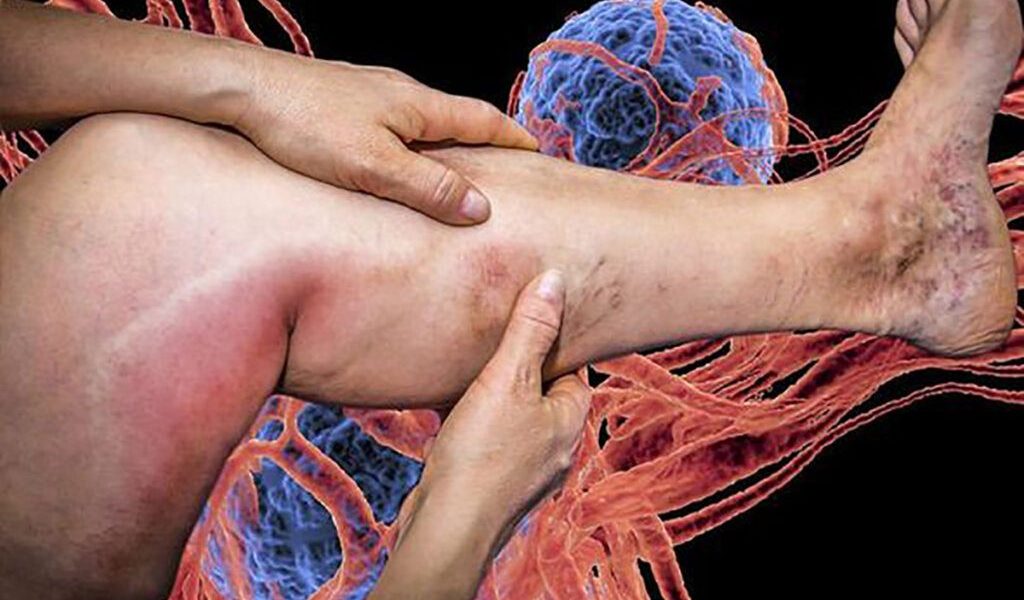 Mecanismul din spatele cheagurilor de sânge, decriptat de cercetători Vaccinurile anti-COVID-19 au salvat milioane de vieți la nivel global, dar un efect secundar rar, însă periculos, a suscitat preocupări în lumea medicală: formarea unor cheaguri de sânge atipice