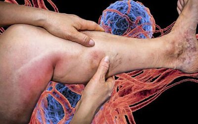 Mecanismul din spatele cheagurilor de sânge, decriptat de cercetători Vaccinurile anti-COVID-19 au salvat milioane de vieți la nivel global, dar un efect secundar rar, însă periculos, a suscitat preocupări în lumea medicală: formarea unor cheaguri de sânge atipice