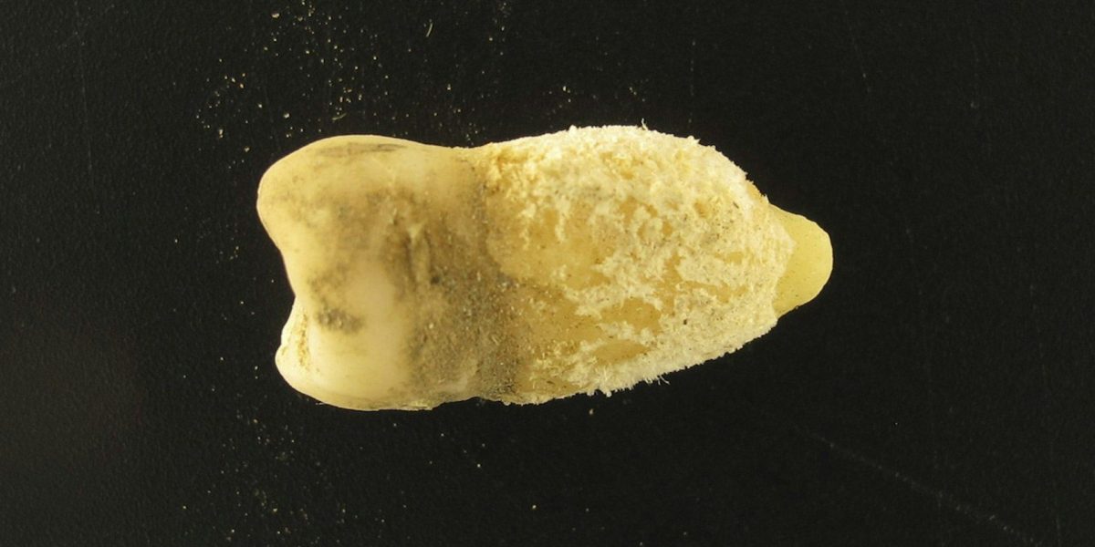 Bacteria scarlatinei, în MUMIE PRECOLUMBIANĂ: Misterul vechii lumi dezvăluit