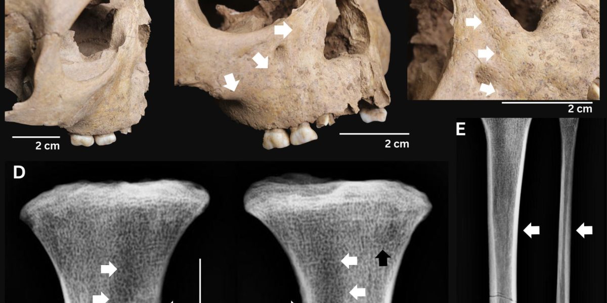 Dinții vechilor copii dezvăluie o boală cruntă ce bântuia acum 4000 de ani