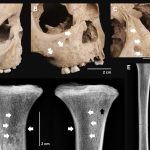 Dinții vechilor copii dezvăluie o boală cruntă ce bântuia acum 4000 de ani