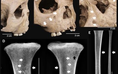 Dinții vechilor copii dezvăluie o boală cruntă ce bântuia acum 4000 de ani