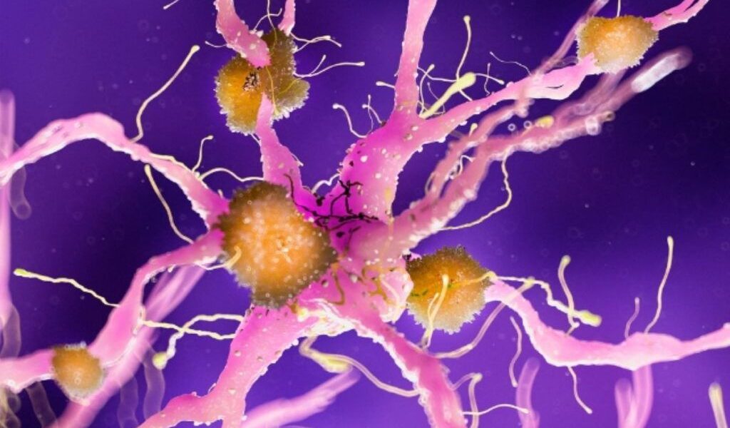 Boala Alzheimer: O nouă perspectivă asupra originii sale, care ar putea schimba abordarea tratamentului Un studiu recent, realizat pe un eșantion vast de pacienți, sugerează o schimbare majoră de paradigmă în ceea ce privește boala Alzheimer