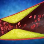 7 SEMNE ALE ARTERELOR BLOCATE: Cardiologii avertizează, mulți le ignoră