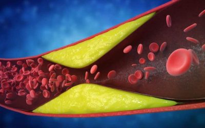 7 SEMNE ALE ARTERELOR BLOCATE: Cardiologii avertizează, mulți le ignoră