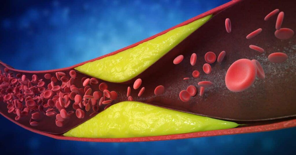 7 SEMNE ALE ARTERELOR BLOCATE: Cardiologii avertizează, mulți le ignoră