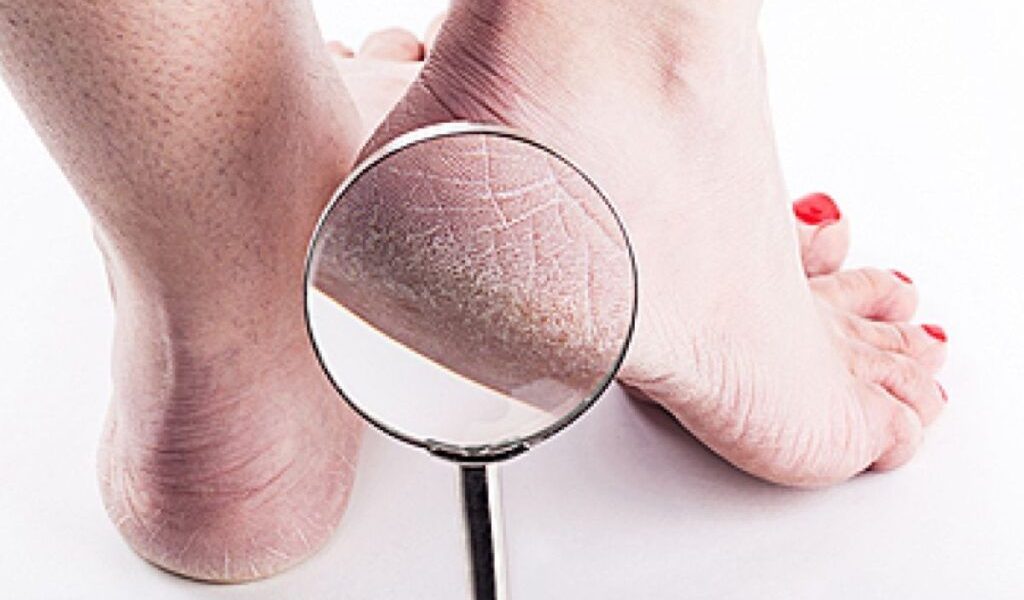 Culoarea călcâielor poate indica o boală de ficat, avertizează un medic