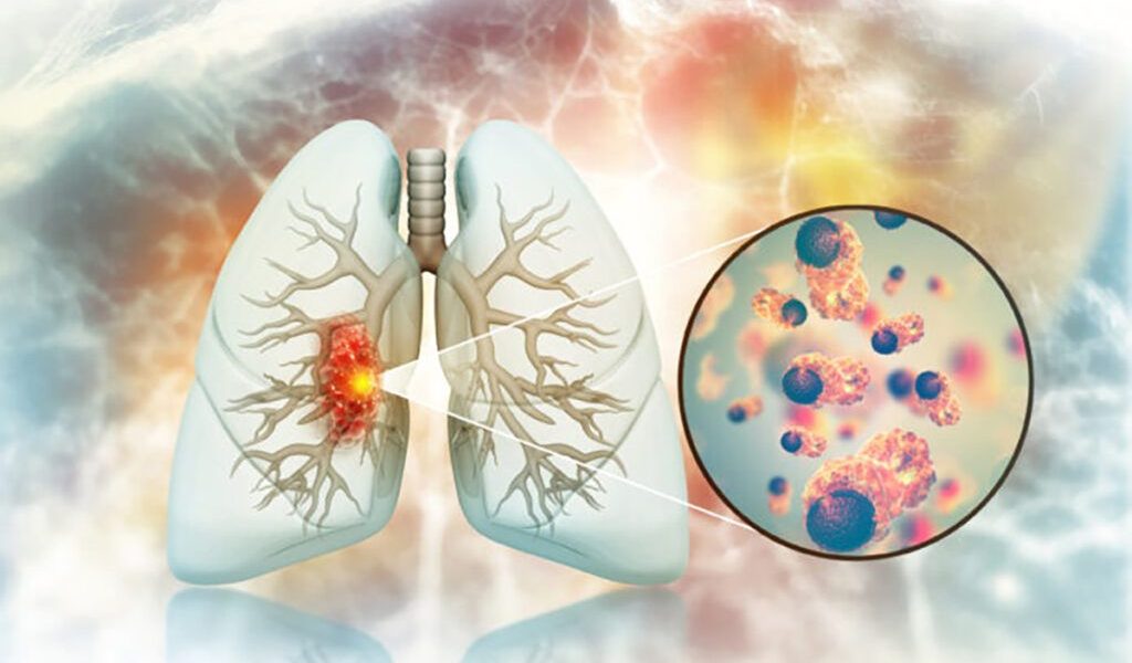 Crește cancerul pulmonar la nefumători: Medicii, uluiți de cauze