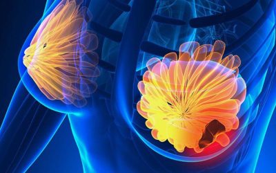 Semnele cancerului de sân: 5 simptome cruciale la care să fii atentă