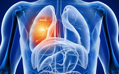 Alarmă după COVID-19: Ce se întâmplă în plămâni după boală în România