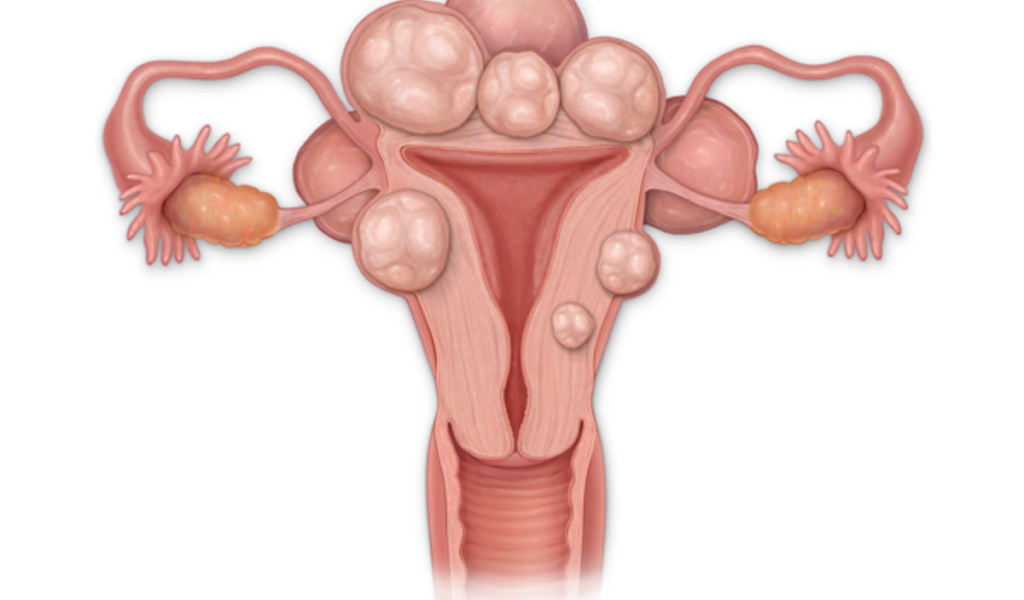 Femeile la vârsta reproductivă se confruntă frecvent cu fibroame uterine, formațiuni benigne care pot afecta fertilitatea