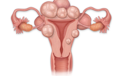 Femeile la vârsta reproductivă se confruntă frecvent cu fibroame uterine, formațiuni benigne care pot afecta fertilitatea
