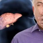 Boala ficatului gras: Tratament revoluționar, fără dietă nouă