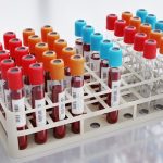 Analiză de sânge revoluționară: Prevede infarctul și AVC mai bine decît colesterolul